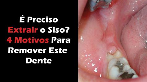 Dente Do Siso Doendo - 4 Motivos Para Extrair o Dente do Siso - Porque a Extração é o Melhor ...