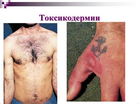 Аллергодерматозы. Дерматиты токсикодермии - презентация онлайн