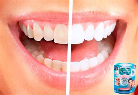 Купить виниры Perfect smile