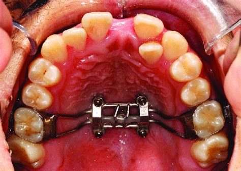 Intraoral photo of the MSE device. | Download Scientific Diagram