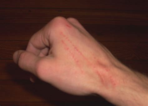 Cat Scratch Fever Can Be Terrifying - Fluffy The Vampire Slayer - Cats ...