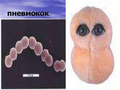 Пневмонія. Етіологія. Патогенез. Клініка. Класифікація. Діагностика ...