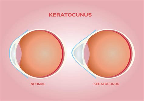The Dangers of Ignoring Keratoconus - TRES VISION Group