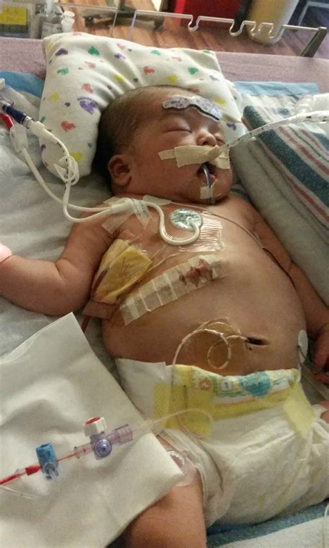 Alicia’s Story: Repairing a Congenital Diaphragmatic Hernia