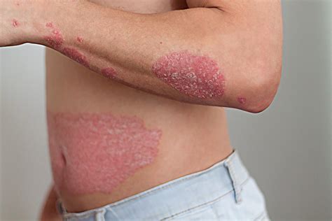 understanding psoriasis symptoms triggers treatments dermatology
