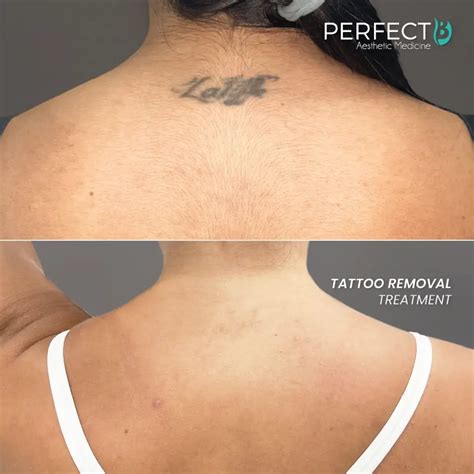 Tattoo Removal Before and After | Perfect B