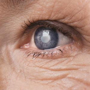 Secondary Cataract: Types, Signs, Impacts and Treatment
