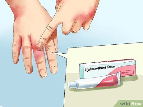 6 Ways to Treat Dermatitis - wikiHow Health