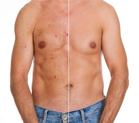 Stryx | Chest Acne | 8 Causes & How to Get Rid of It