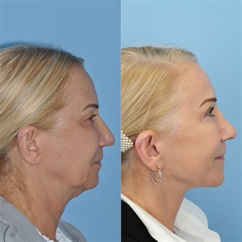 These Are Haute Surgeon’s Most Prized Before And After Photos - Haute