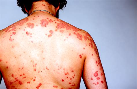 Sintomas Do Hiv Na Pele - Rosto De Pele Hiv
