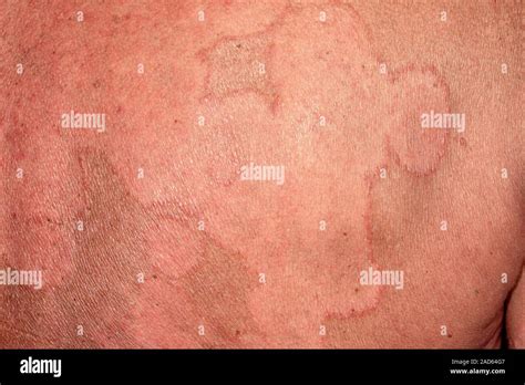 ringworm rash close    rash       year  male