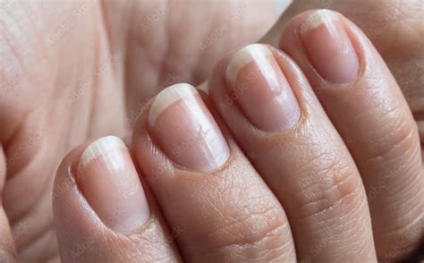 nail pitting symptoms archives myhealthopedia