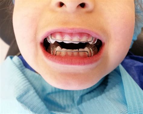 Ortopedia Dental Infantil en Quito - Clínica Dental Novulis