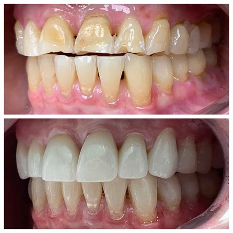 veneers     overview   veneers options