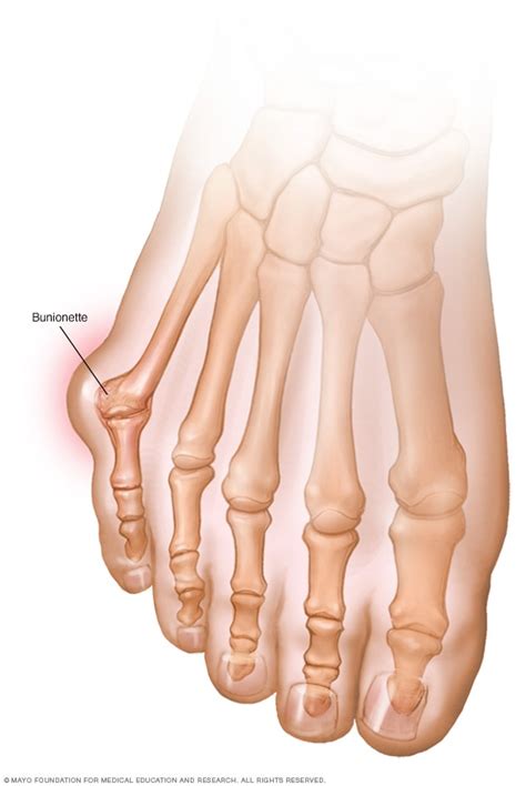 Bunions - Symptoms and causes - Mayo Clinic