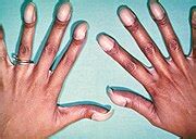 categorynail clubbing wikimedia commons
