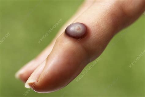 wart treatment stock image  science photo library