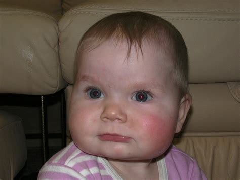 если у нас одна щека красная... — 22 ответов | форум Babyblog