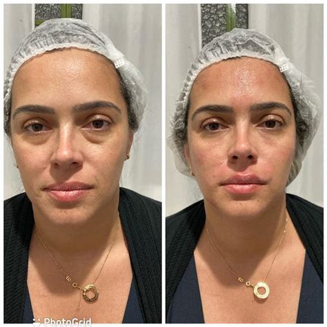Botox Arquear Sobrancelha Antes E Depois - Botox: Antes e depois em 20 Fotos