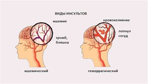 Сосудистые заболевания головного мозга, инсульт, микроинсульт.