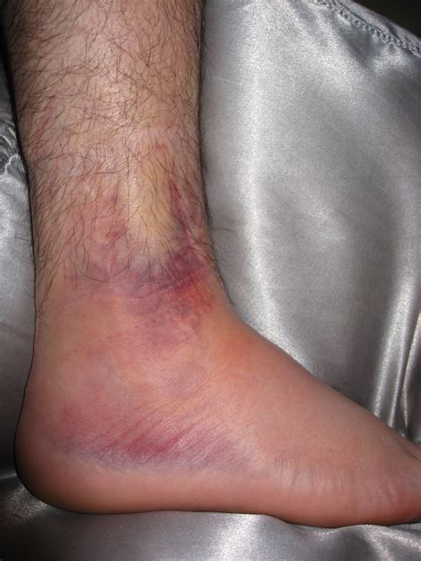Ankle swell and internal bleeding | Ankle swell and internal… | Flickr