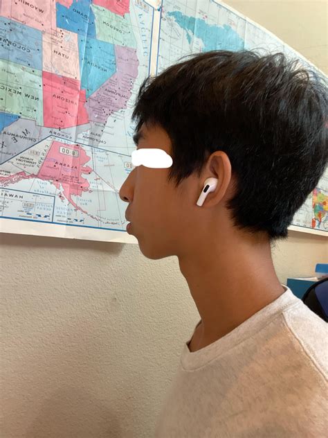 extremely slanted  jaw rorthotropics