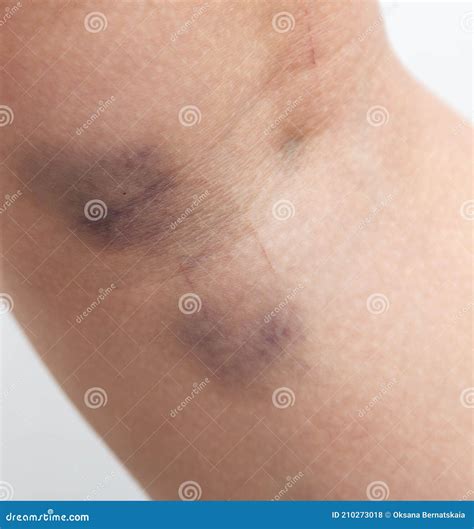 how to disguise a bruise 3