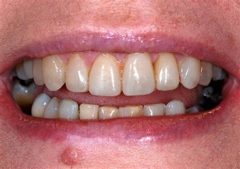 treating bad teeth affordable options teatments cap city dental