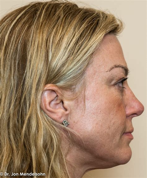 Eyelid Services – Advanced Cosmetic Surgery & Laser Center