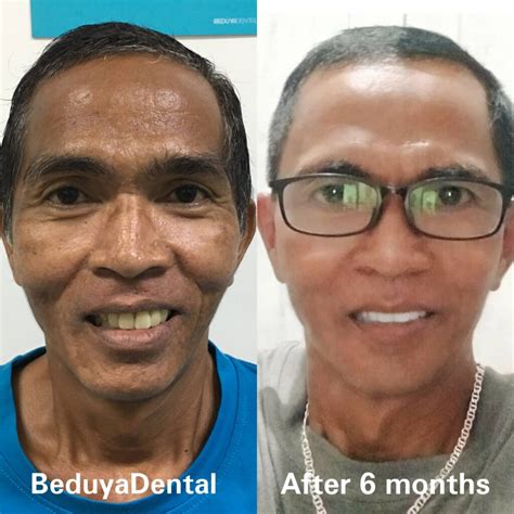Non-surgical Face Contouring - Beduya Dental