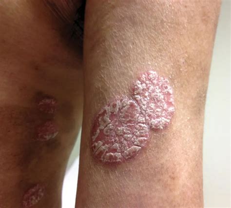 plaque  skin lesions