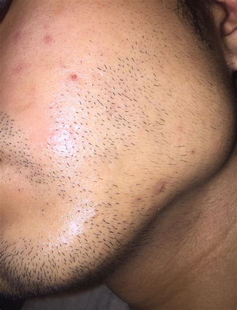 Vellus Hair Almost Never Has A at Joan Stone blog