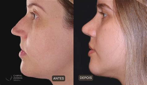 Rinoplastia Antes E Depois