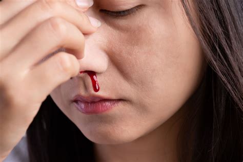Sonhar Com O Nariz Sangrando - Sonhar Com Sangue No Nariz - FDPLEARN