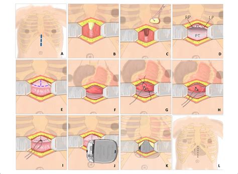 Minimally Invasive Epicardial Pacemaker Implantation in Neonates with