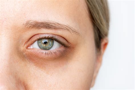 Dark Circles Under the Eyes: Causes and Treatments to Remove or Reduce