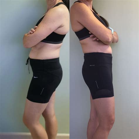 Before & After Gallery – Slim Me