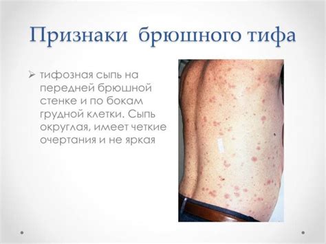 Презентация - Брюшной тиф » Привет Студент!