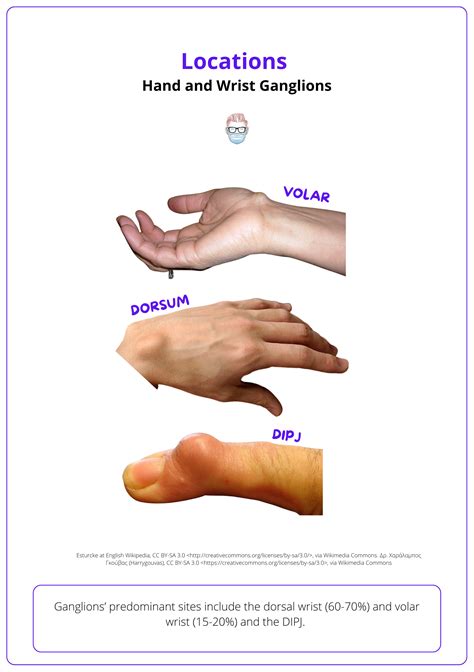 Volar Vs Dorsal Hand