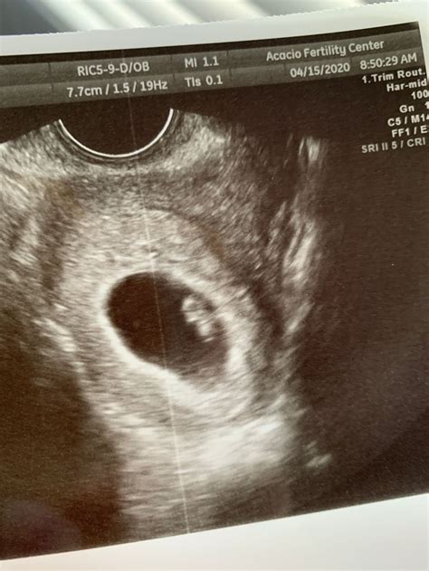 6 Week Ultrasound Heartbeat