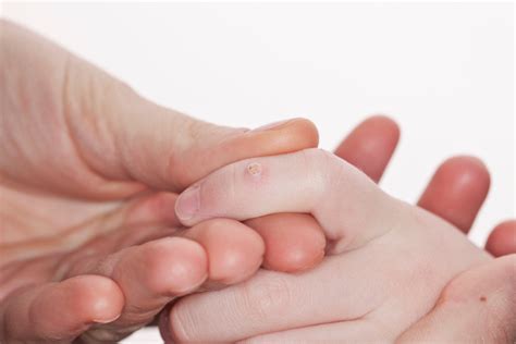 Бородавки у детей: причины и способы лечения - Parents.ru | Счастливые ...