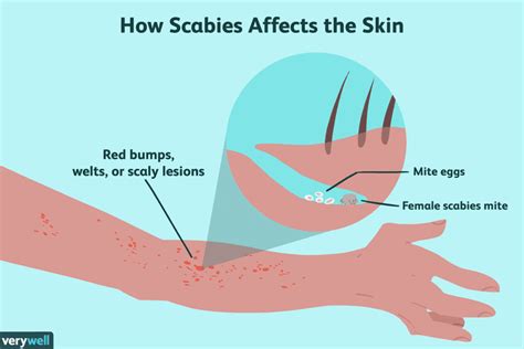 Scabies: Overview and More