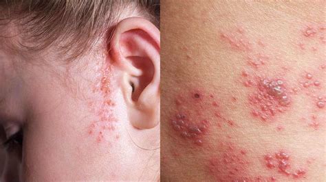 Unraveling the Mystery: Rashes as Detoxification Symptoms | Heidi Salon
