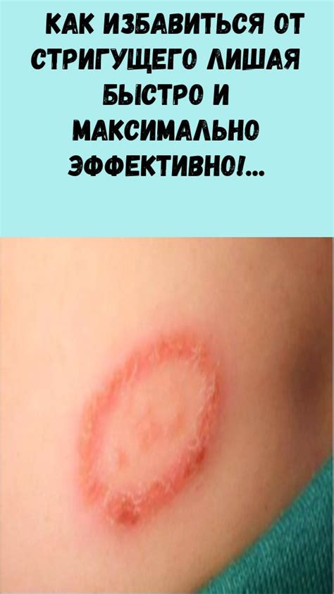 Как избавиться от стригущего лишая быстро и максимально эффективно ...
