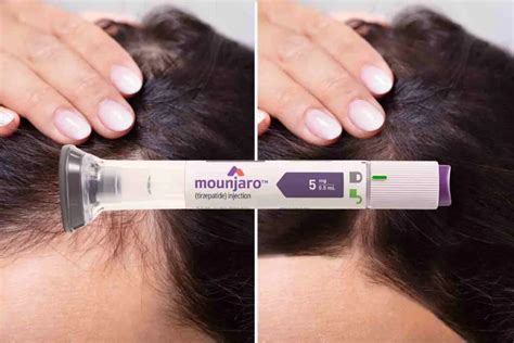 Mounjaro E Queda De Cabelo - Helpful Mounjaro Hair Loss Info For Anyone Taking GLP-1