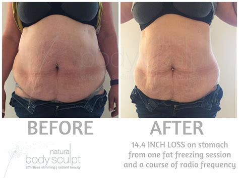 Fat Freezing - Ice Lipo | Natural Body Sculpt