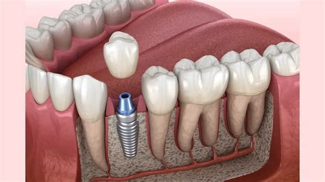 single tooth implant simple guide   missing tooth