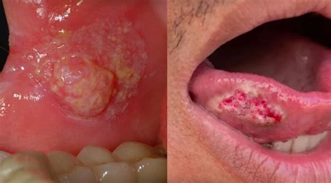Como Diferenciar Afta De Cancer De Boca - Câncer de boca: o que é, sintomas, causas e tratamento