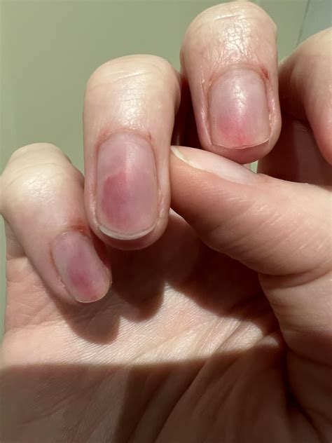 cut nails too short 2